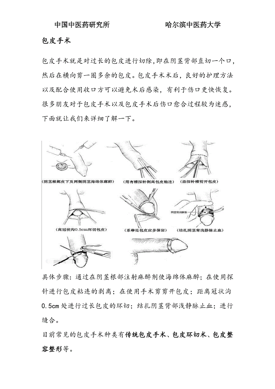 包皮手术后伤口愈合图片详解