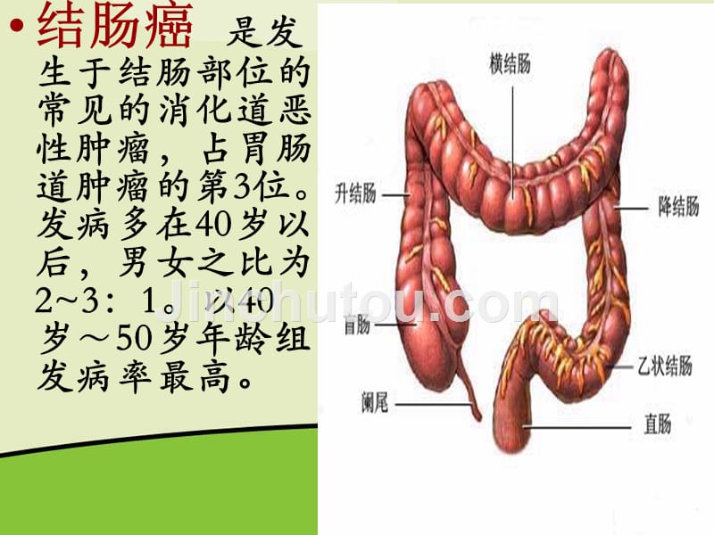 206年1月乙狀結腸癌護理1副本