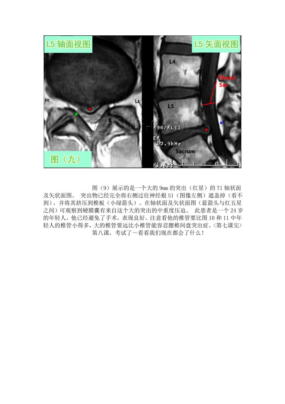 教你如何看腰椎间盘突出ct和mr片