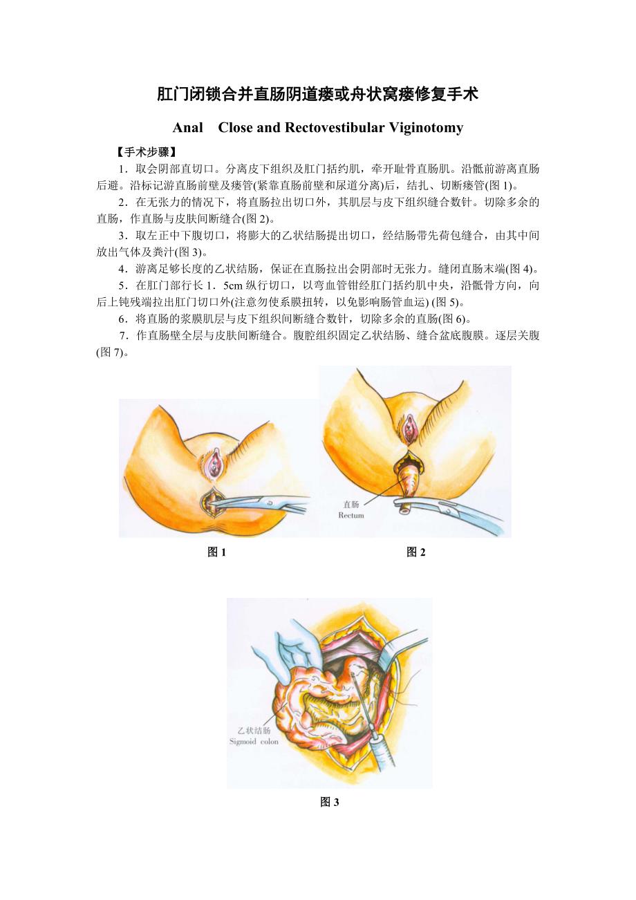 肛门闭锁合并直肠阴道瘘或舟状窝瘘修复手术