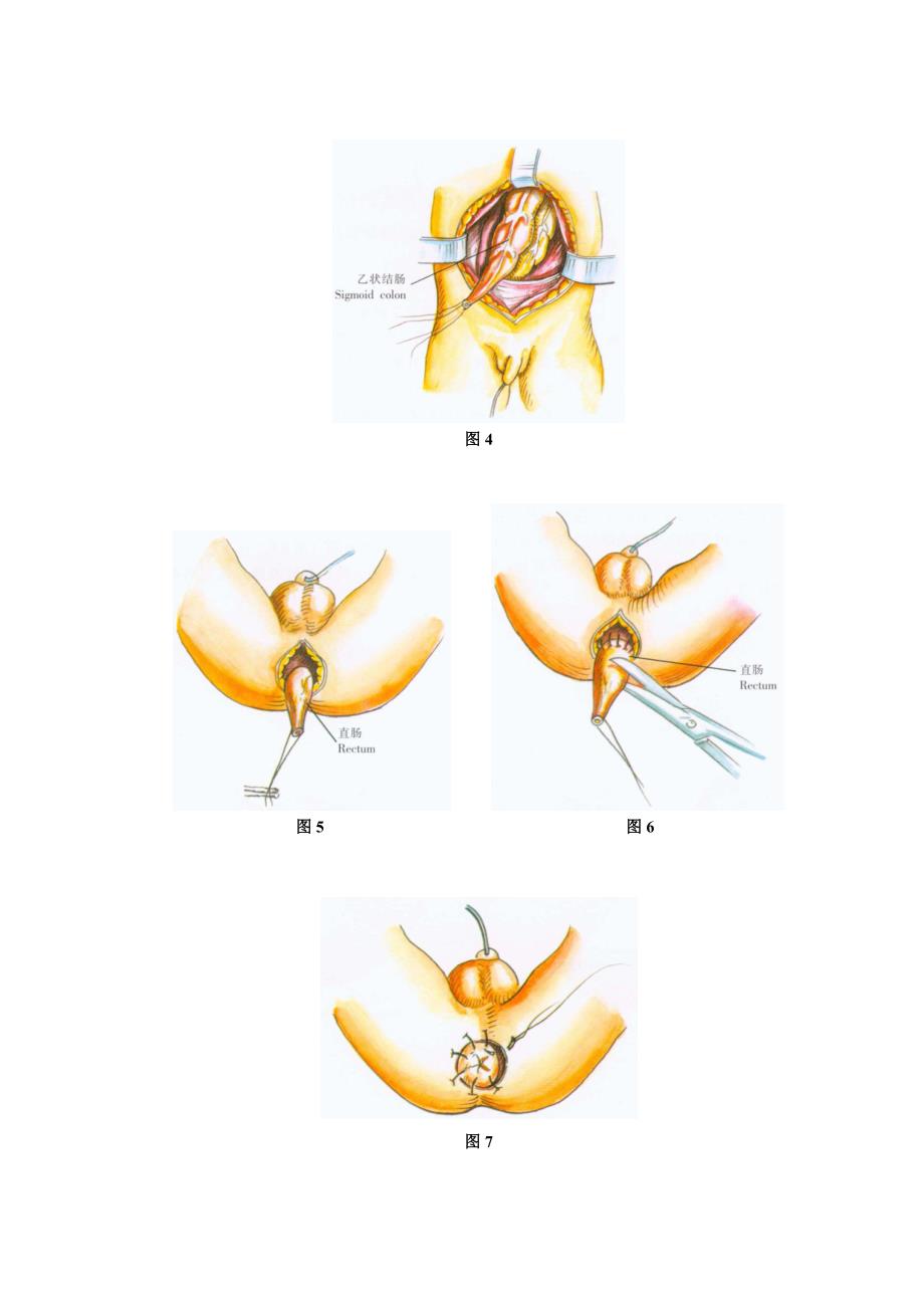 肛门闭锁合并直肠阴道瘘或舟状窝瘘修复手术